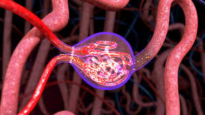 Glomerular disease and nephrotic syndrome treatment in Jaipur