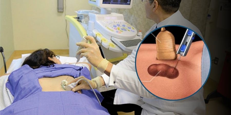 Renal biopsy and kidney stone evaluation in Jaipur