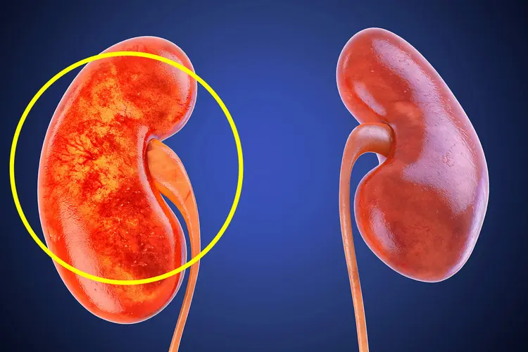 Diabetic kidney disease and nephropathy treatment in Jaipur