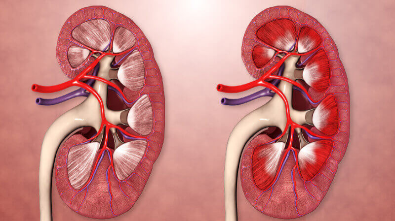 Glomerular disease and nephrotic syndrome treatment in Jaipur