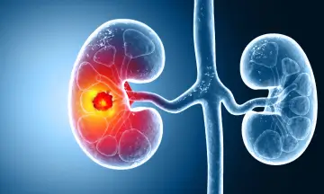 Kidney transplant consultation and care